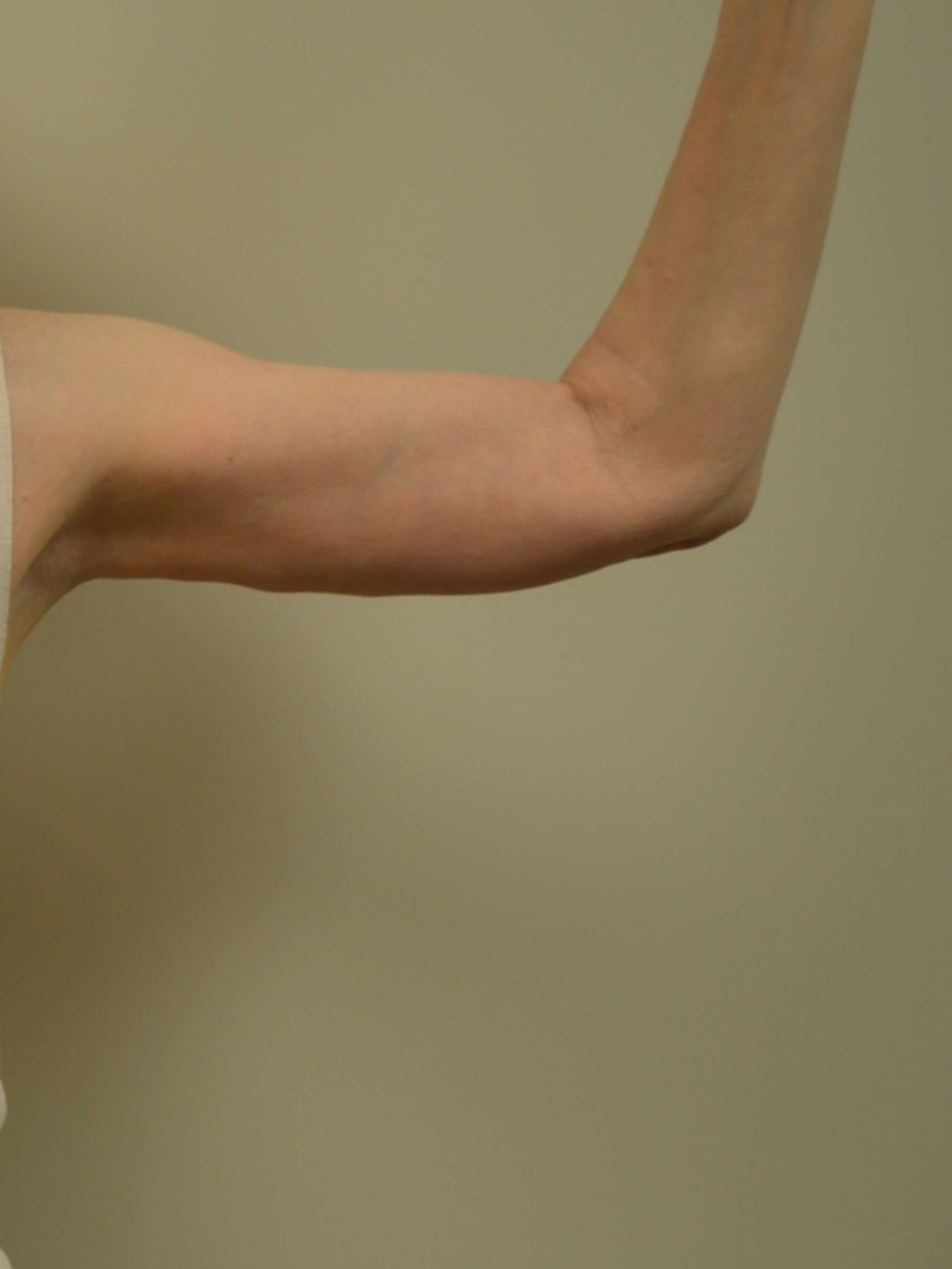 Arm Lift After