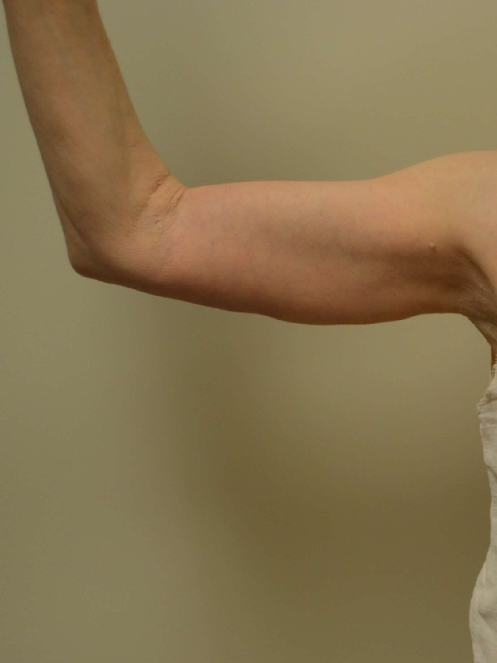 Arm Lift After