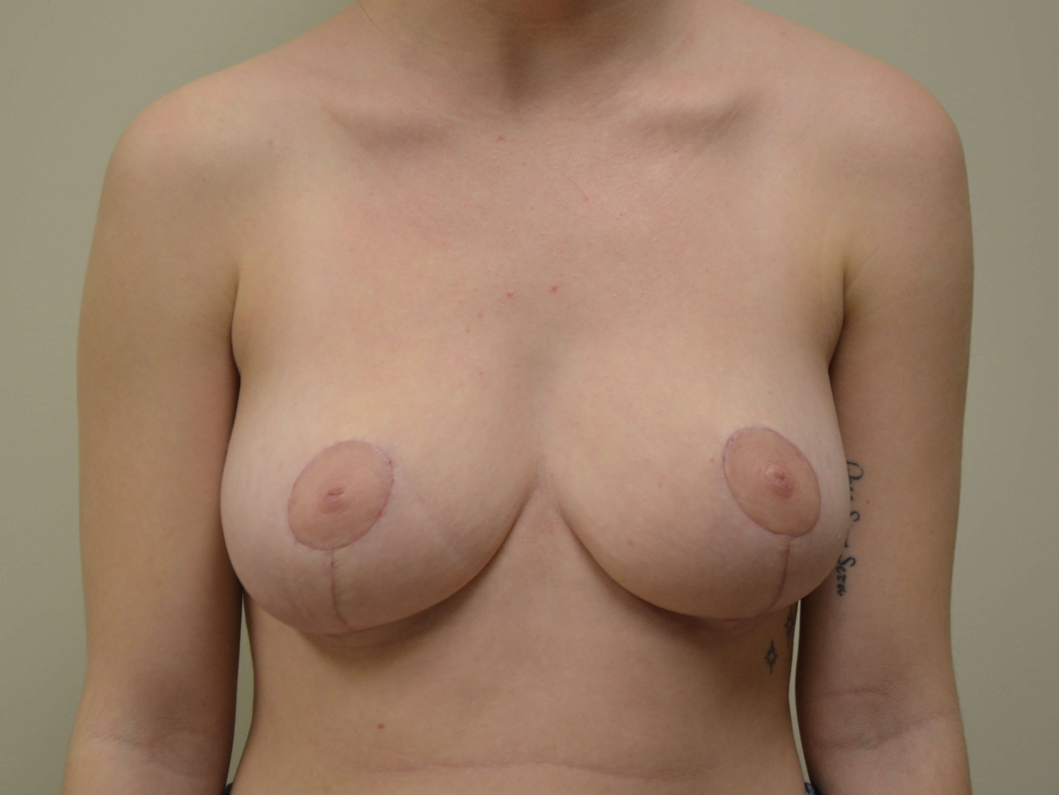 Breast Reduction & Lift After