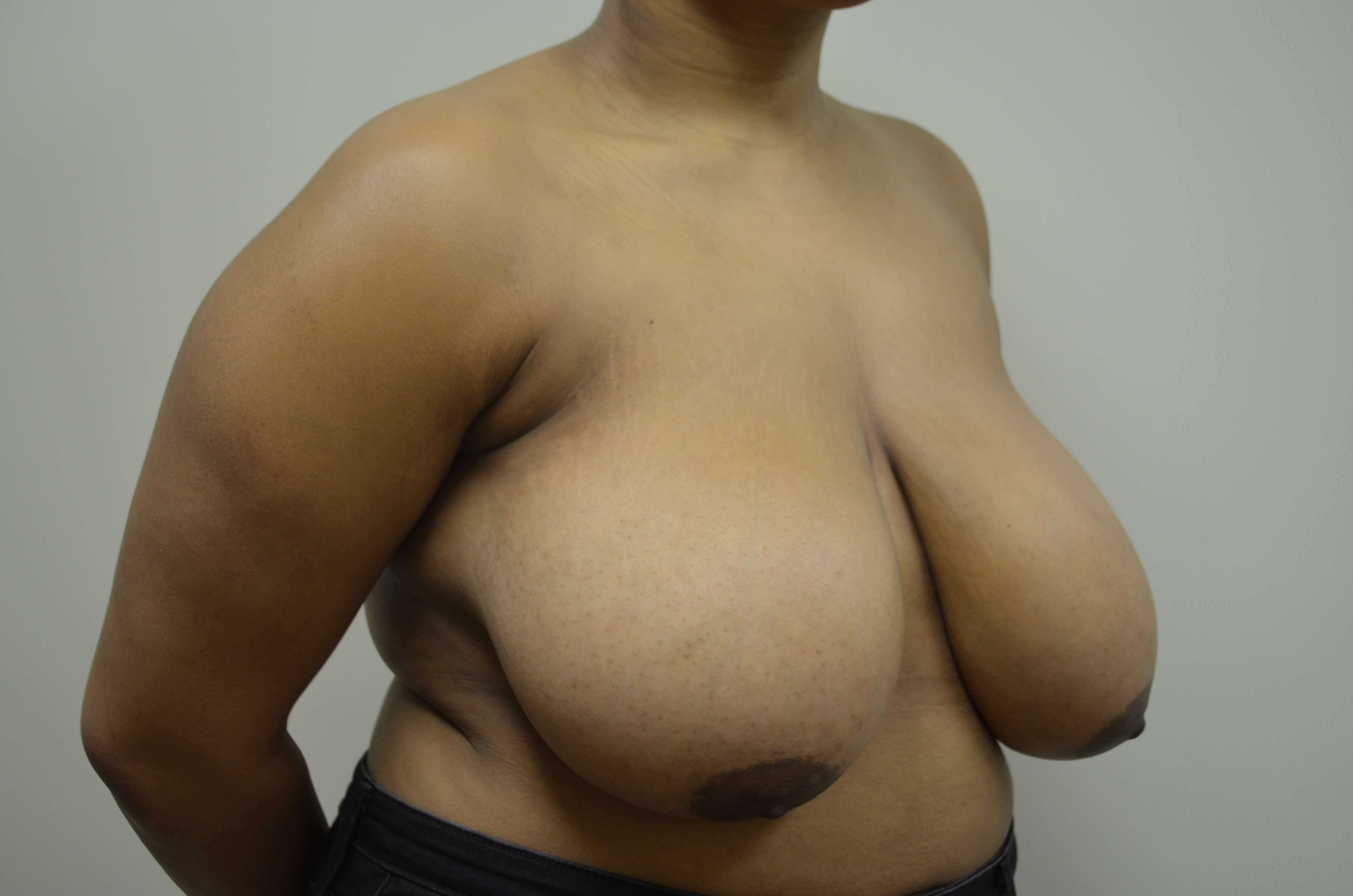Breast Reduction & Lift Before