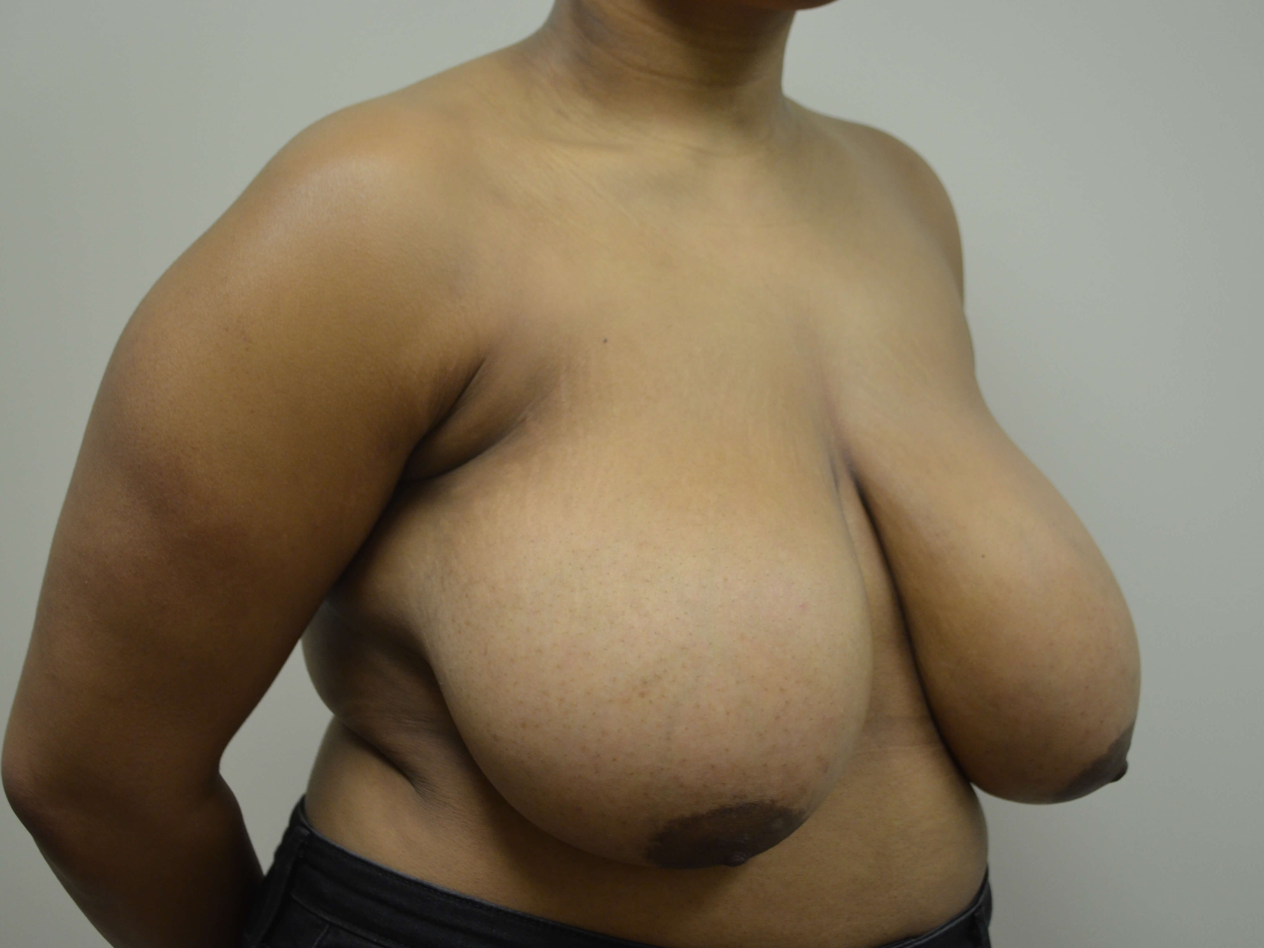 Breast Reduction & Lift Before