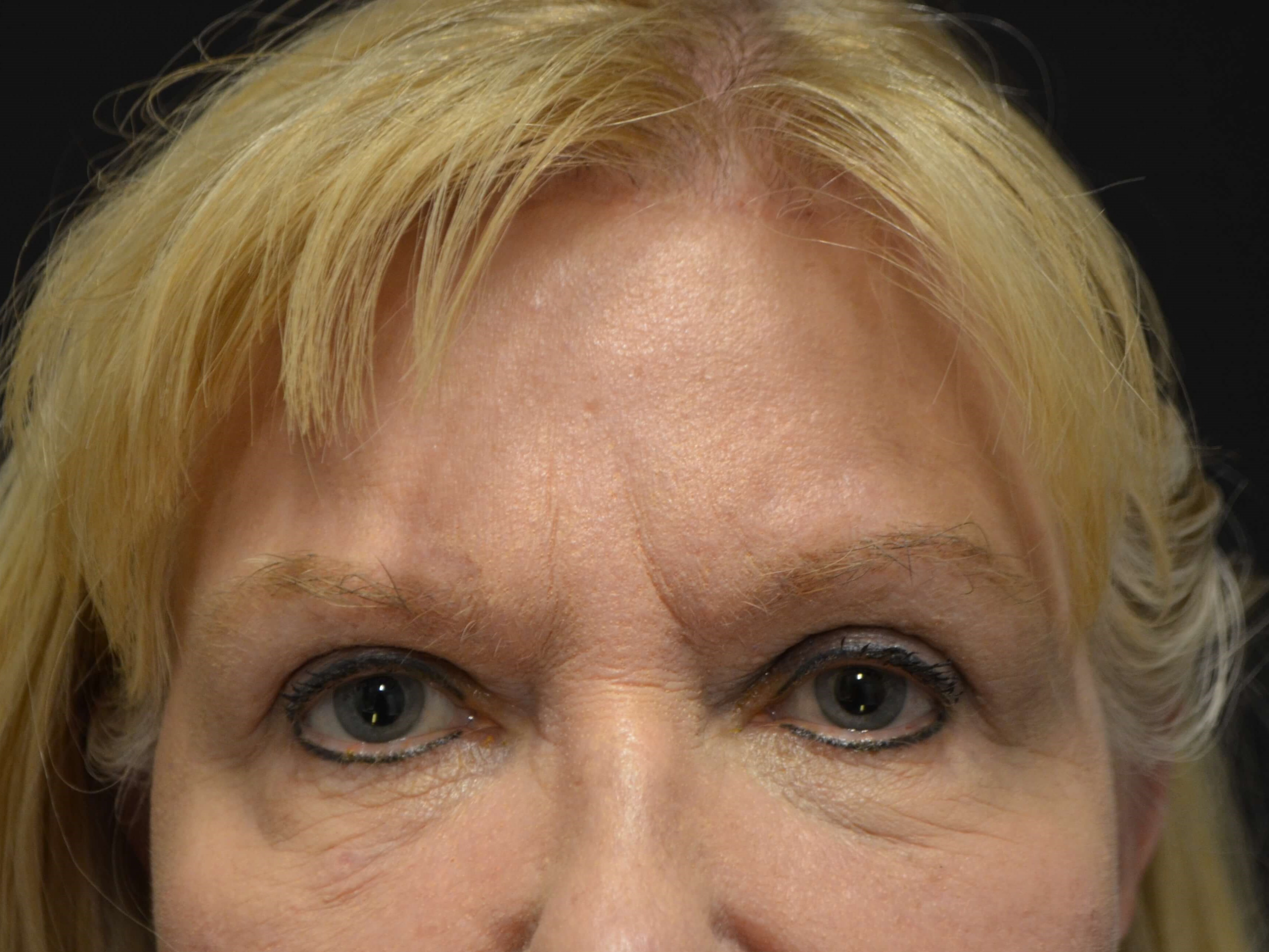 Upper Eyelid Lift After