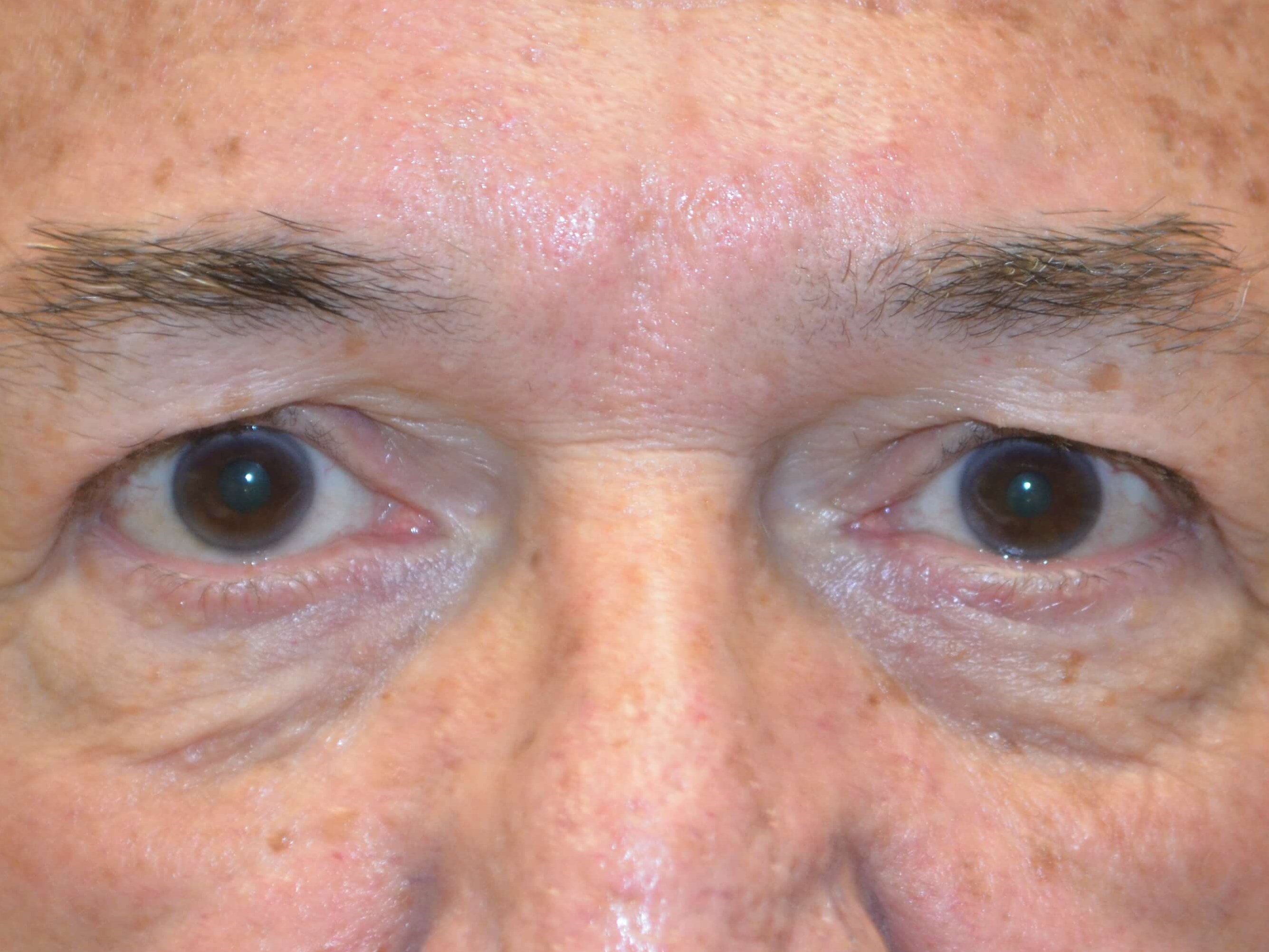 Upper Eyelid Lift Before