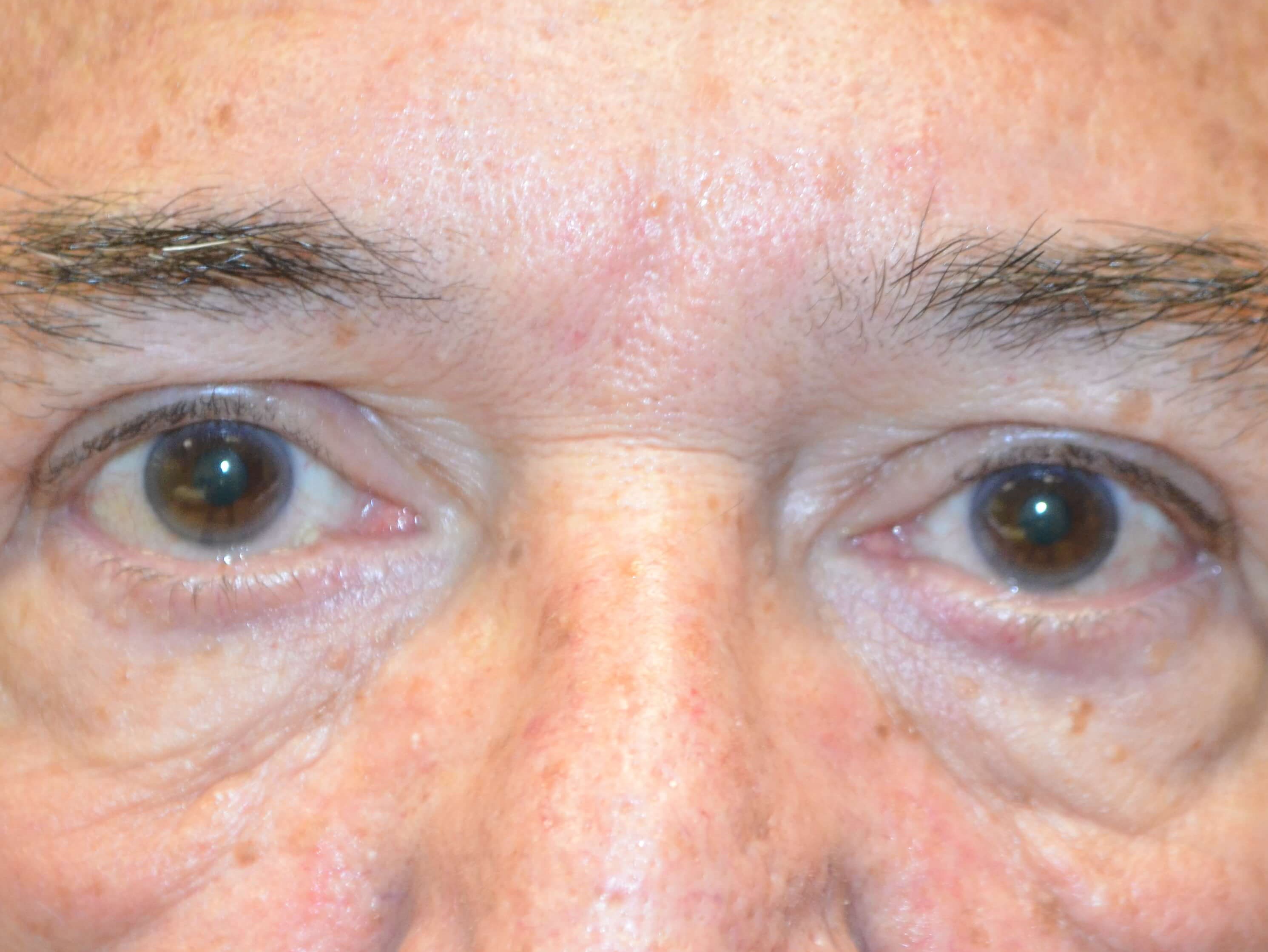 Upper Eyelid Lift After