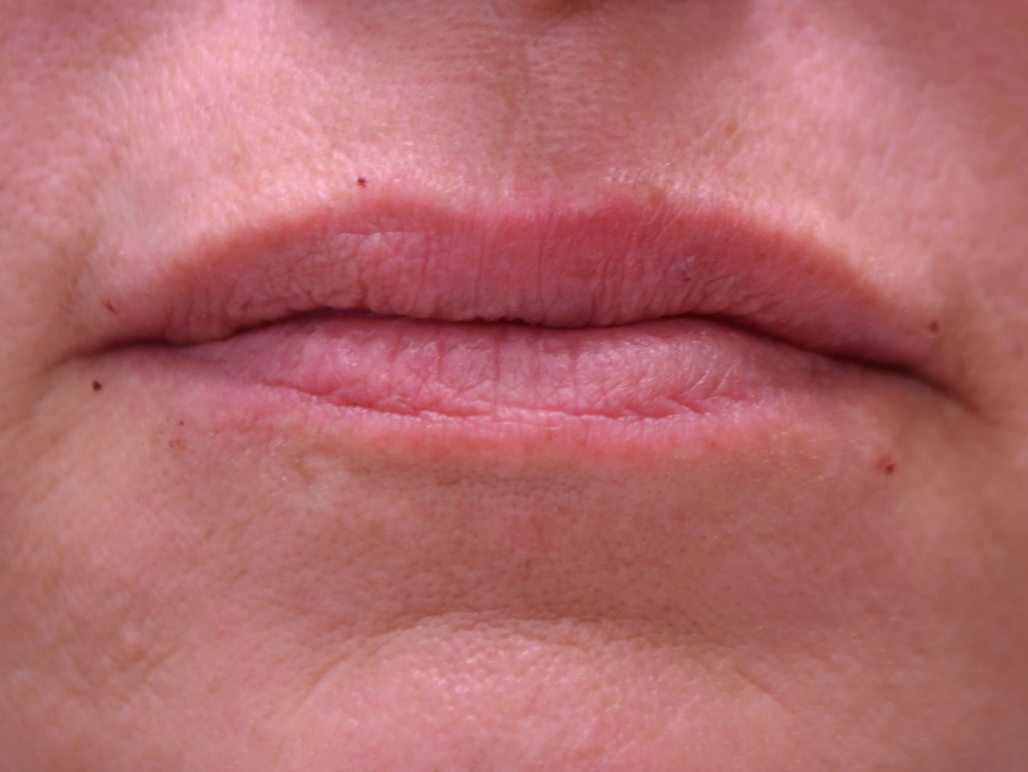 Lip Enhancement-Juvederm After