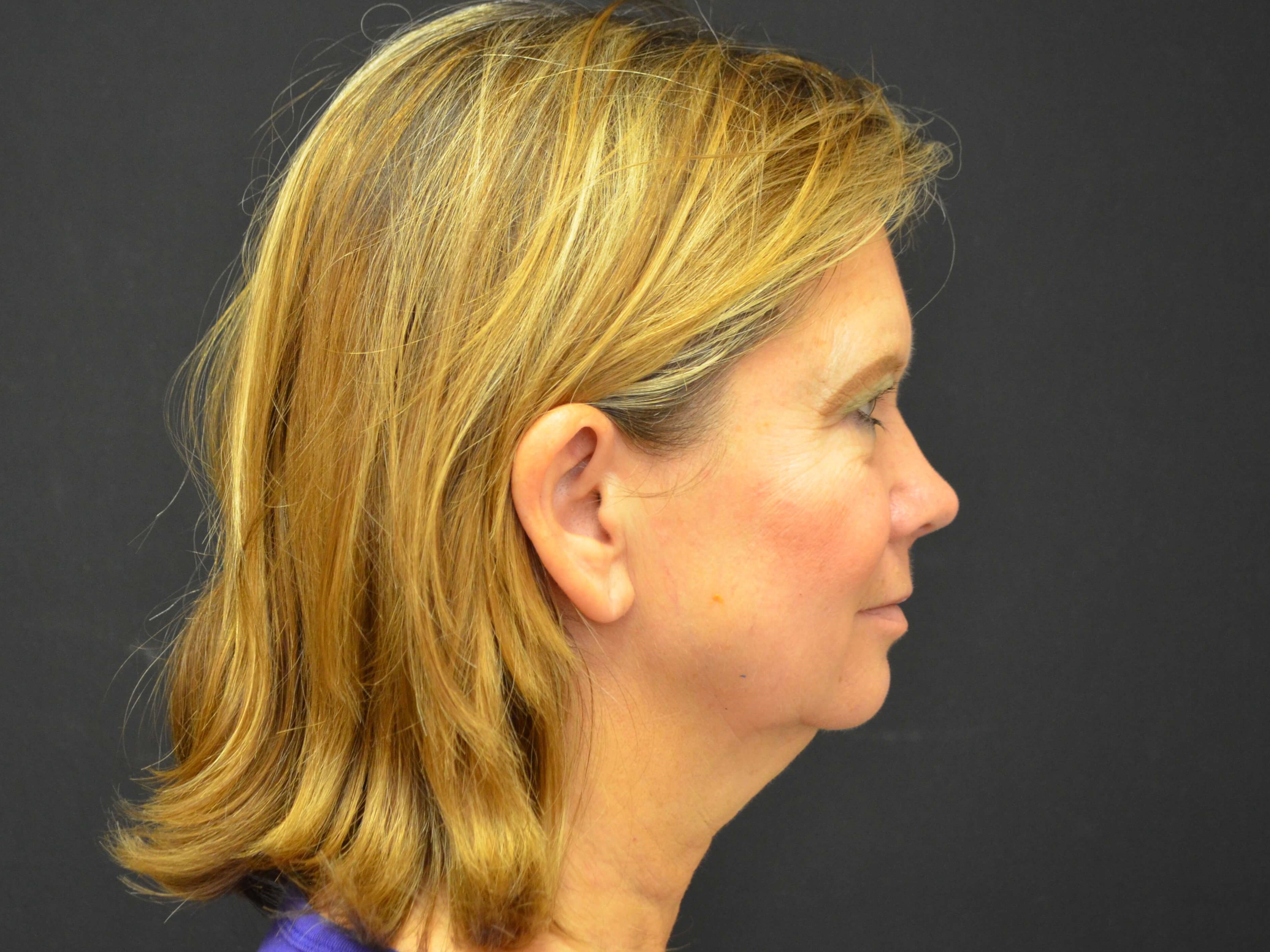 Lower Face & Neck Lift Before