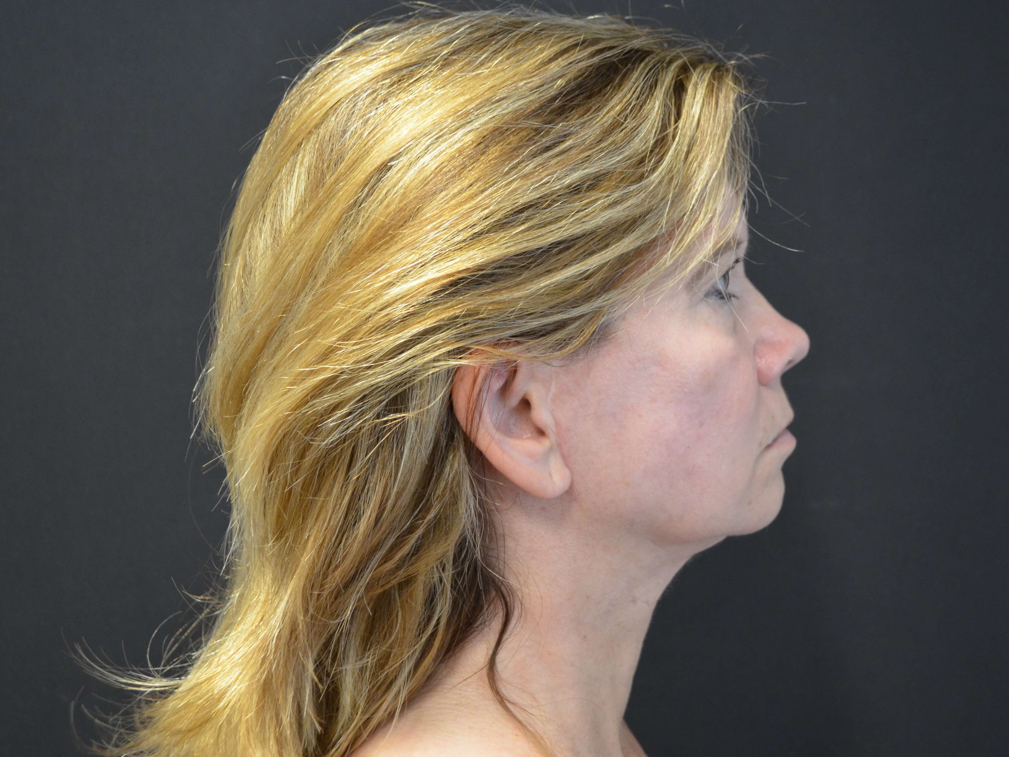 Lower Face & Neck Lift After