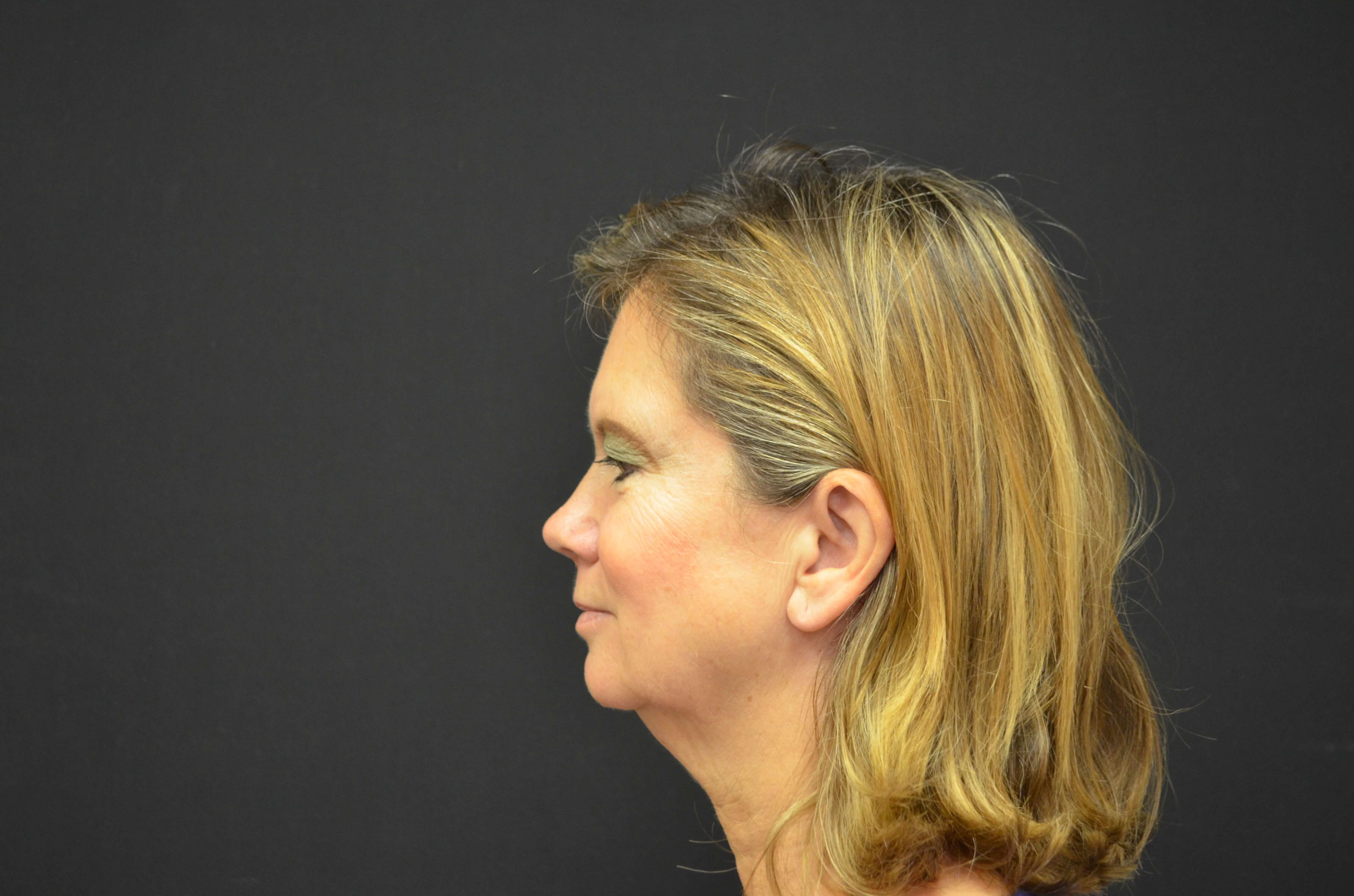 Lower Face & Neck Lift Before