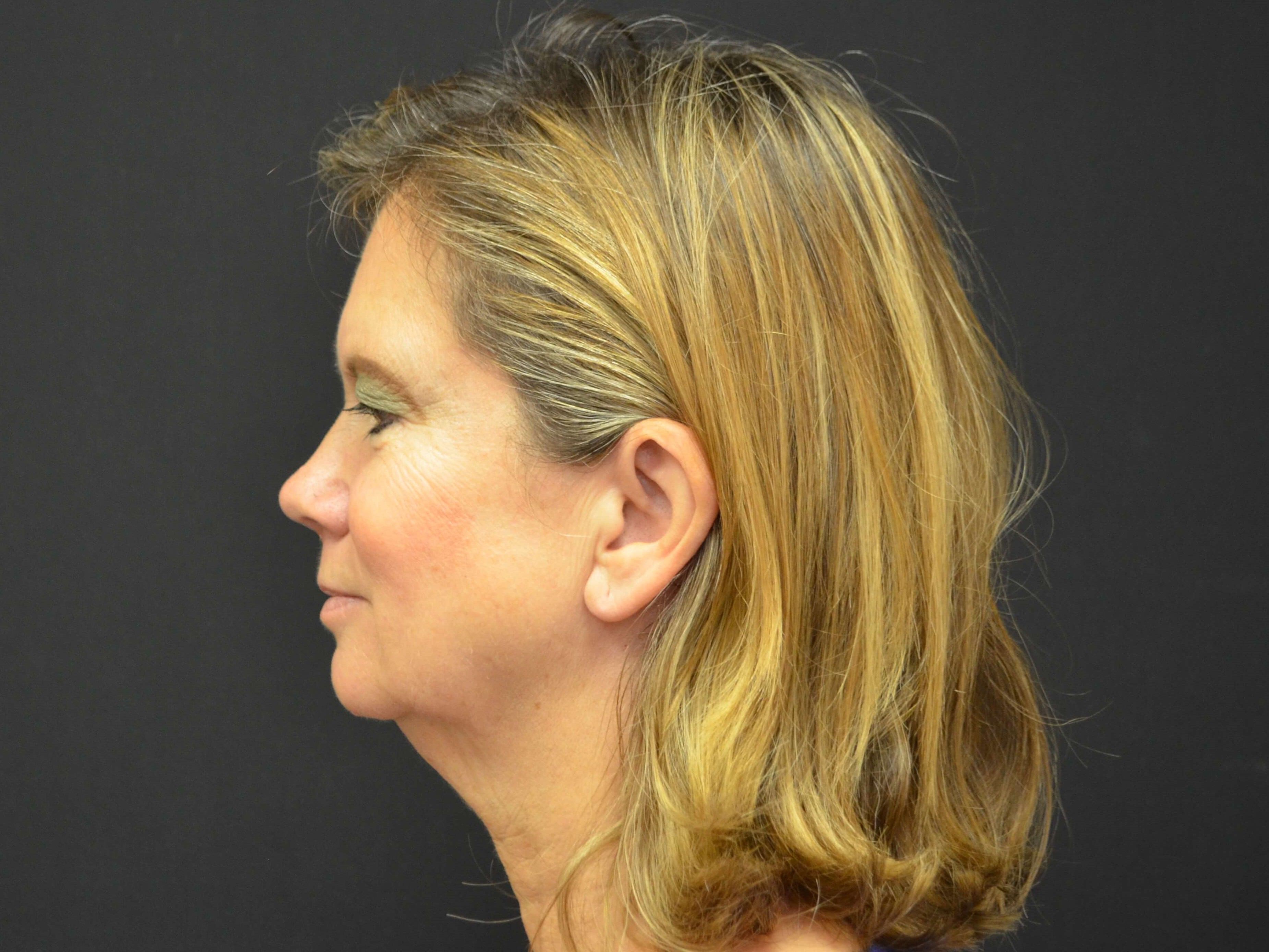 Lower Face & Neck Lift Before