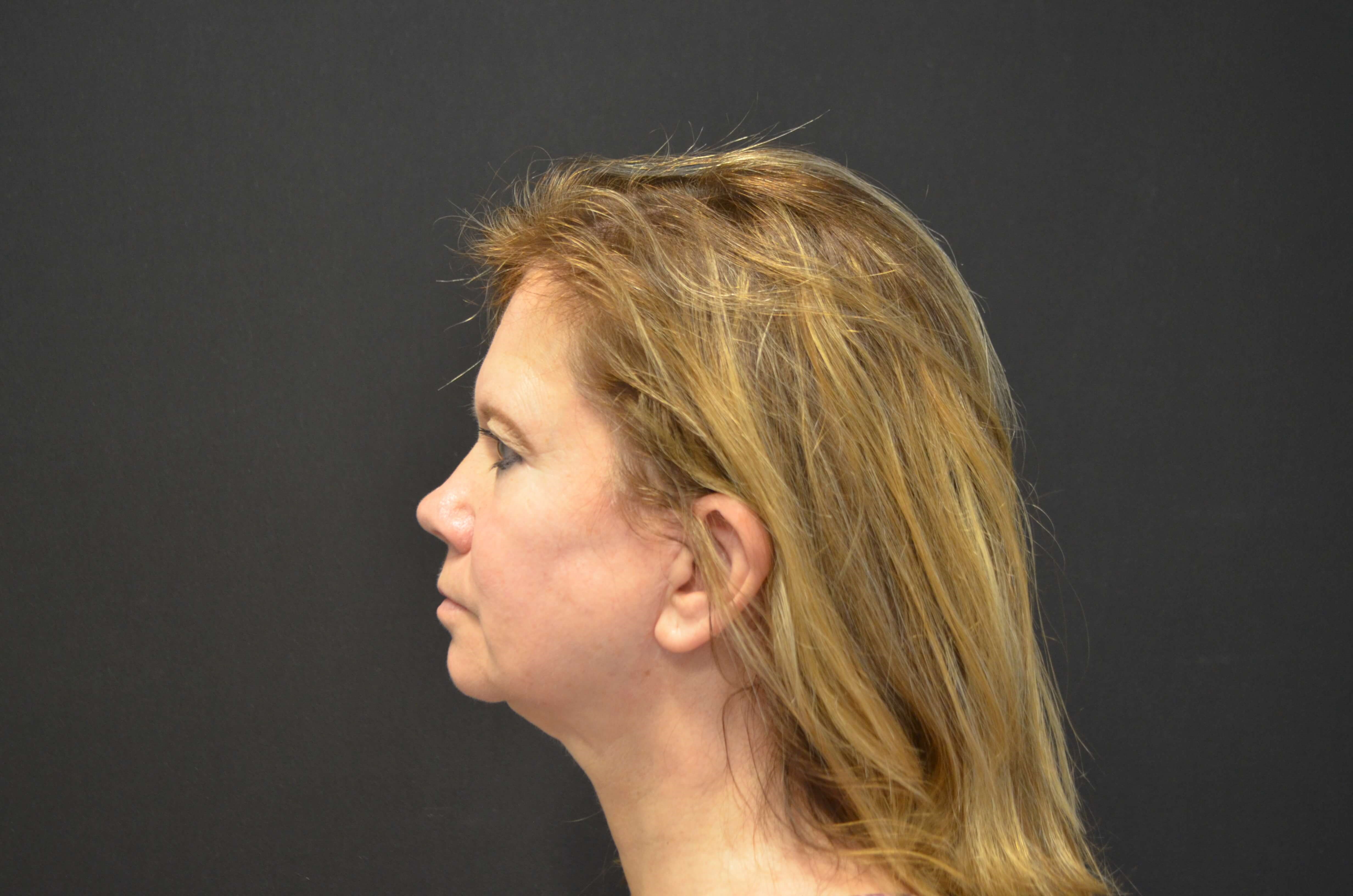 Lower Face & Neck Lift After