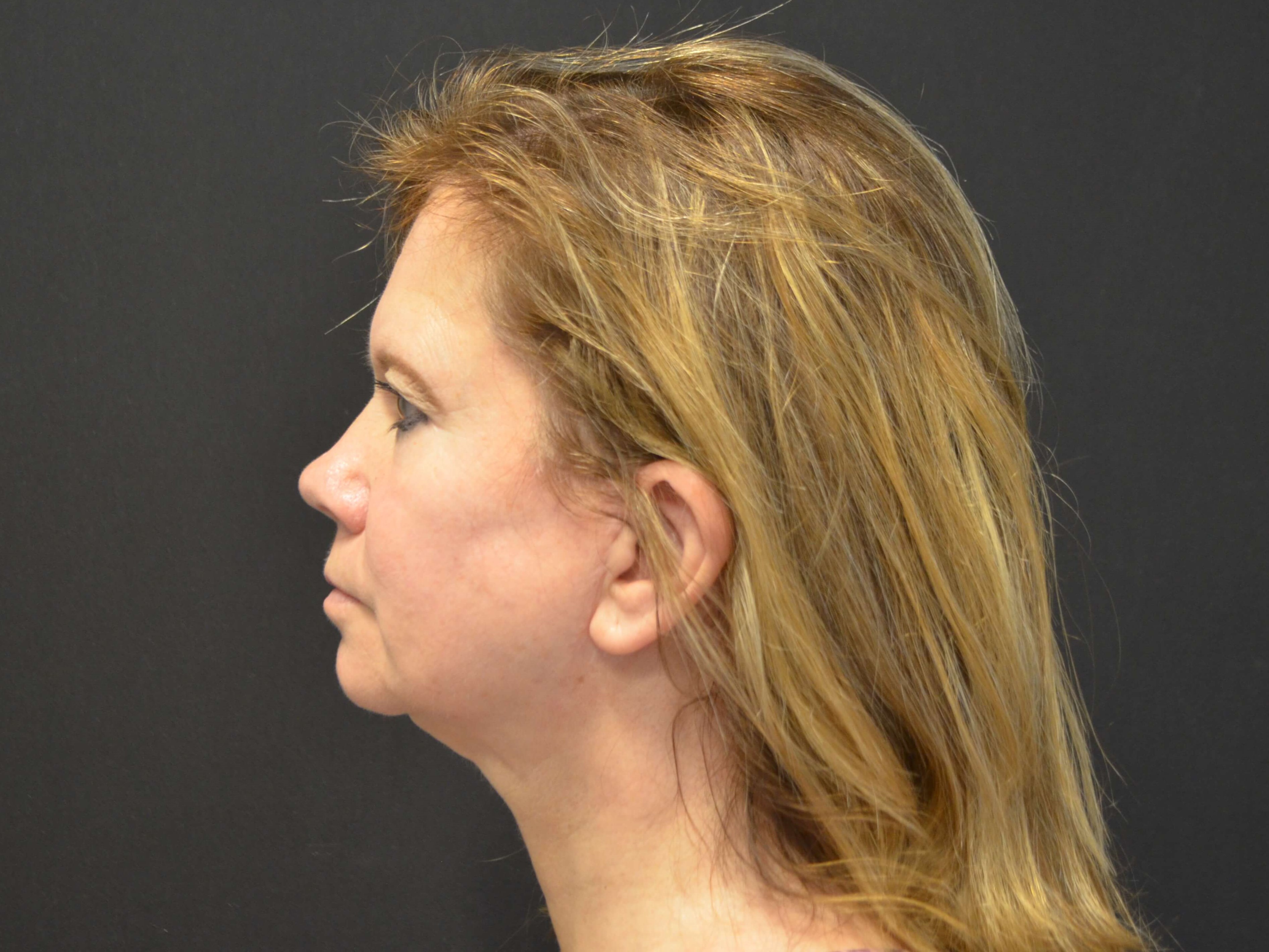 Lower Face & Neck Lift After