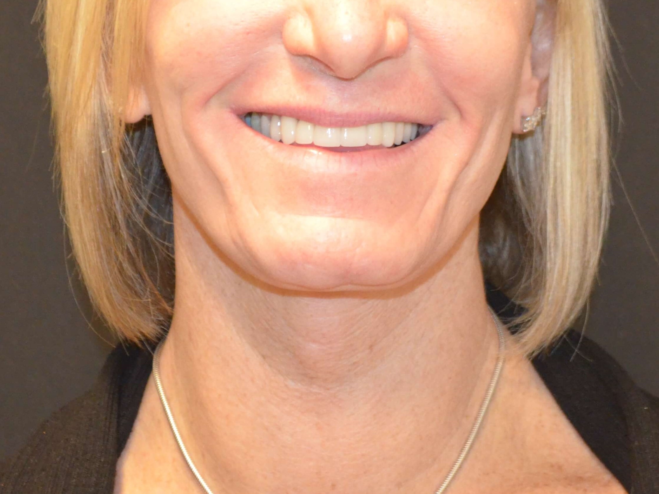 Lower Face & Neck Lift After