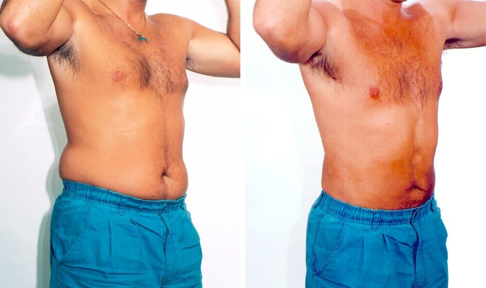 liposuction for obese men